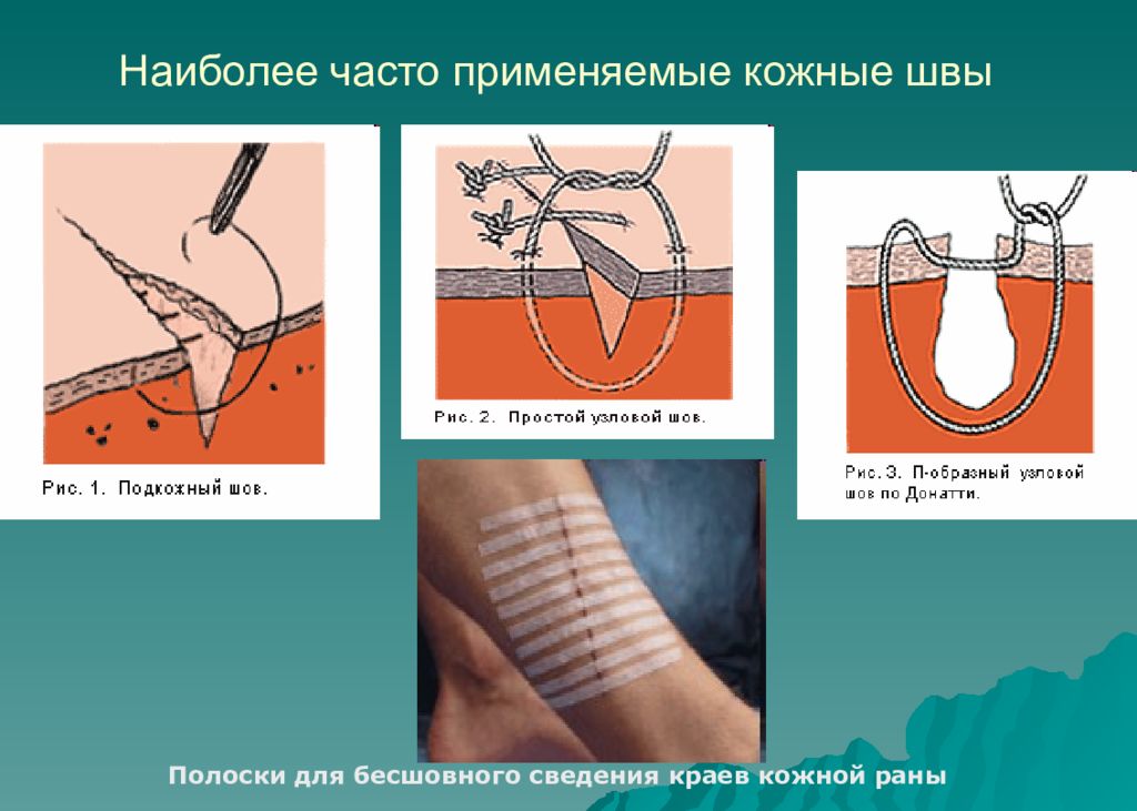 Хирургические швы презентация