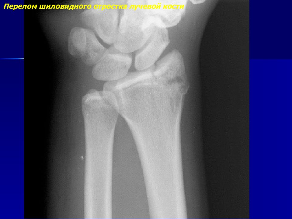 Шиловидная кость. Перелом шиловидного отростка лучевой кости. Перелом лучевой кости с отрывом шиловидного отростка. Лучевая кость шиловидный отросток перелом. Перелом шиловидного отростка локтевой кости.