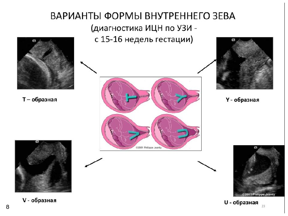 Истмико цервикальная недостаточность презентация