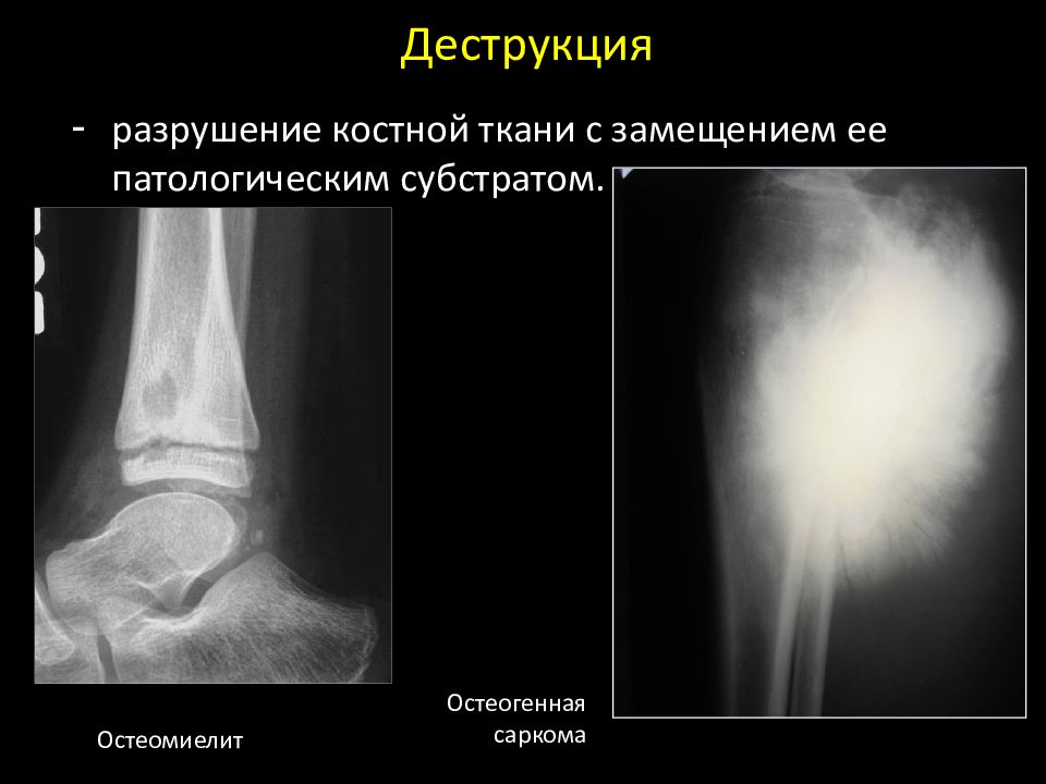 Деструкция костной ткани. Очаг деструкции костной ткани рентген. Лучевая семиотика костно-суставного аппарата. Деструкция кисти ренгтен. Дистрофическая деструкция кости.