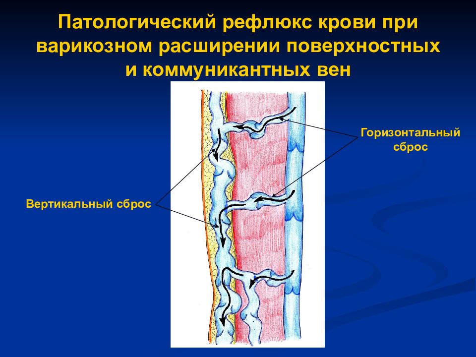 Рефлюкс нижних конечностей. Горизонтальный вено-венозный рефлюкс. Вертикальный вено-венозный рефлюкс. Рефлюкс патологический вен нижних. Вертикальный и горизонтальный рефлюкс вен.