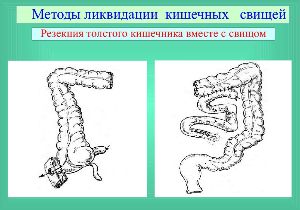 Лечение кишечных свищей