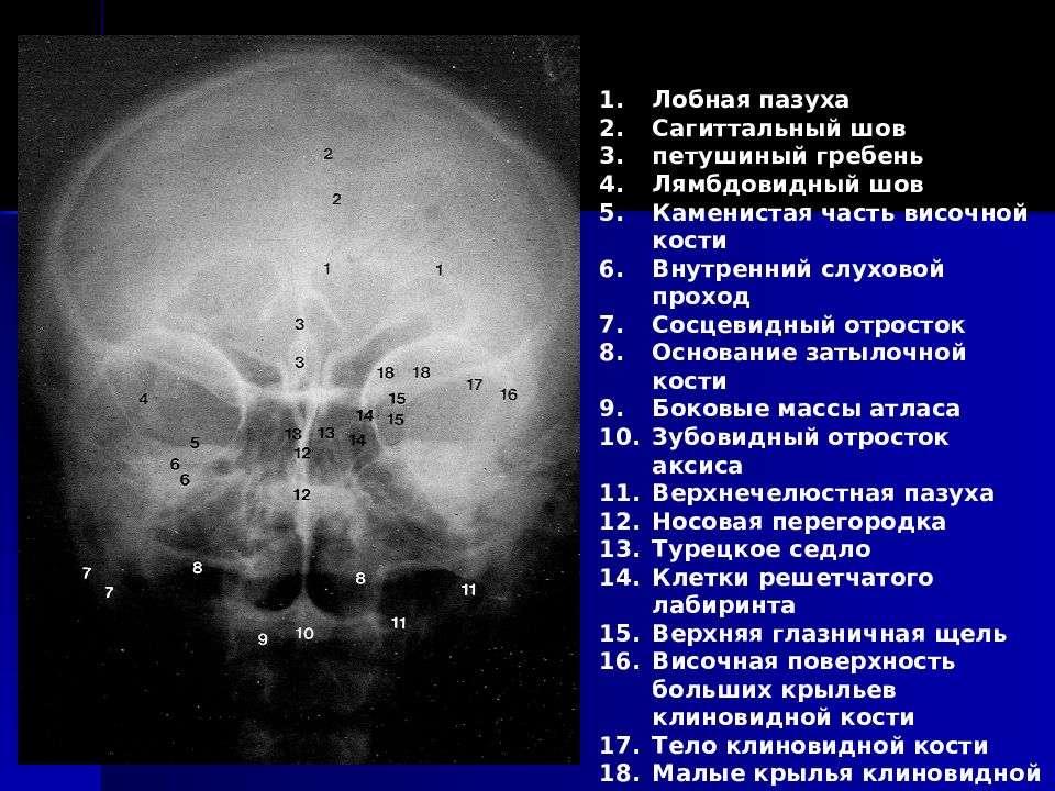 Швы лобной кости