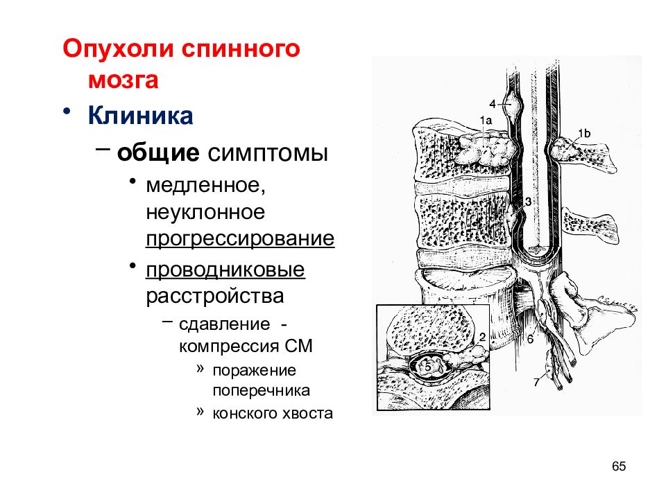 Опухоли головного и спинного мозга презентация