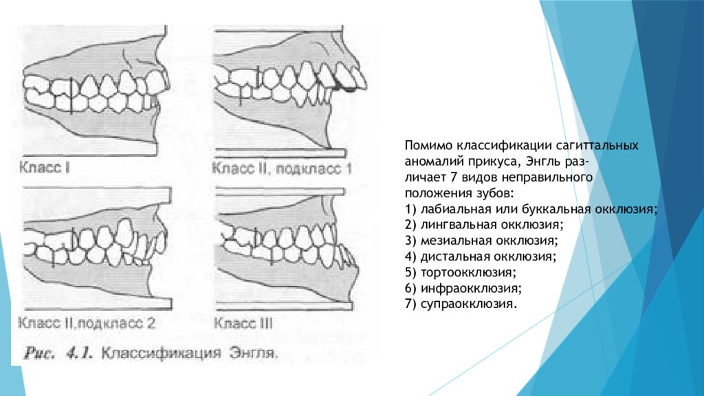 Классы окклюзии