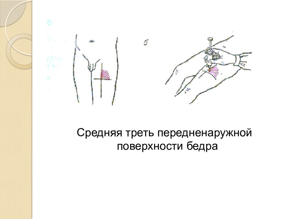 Как ставить в бедро внутримышечно. Передне-боковая поверхность бедра верхняя треть. Постановка внутримышечной инъекции в бедро алгоритм. Схема введения внутримышечной инъекции. Внутримышечно в переднебоковую поверхность бедра.