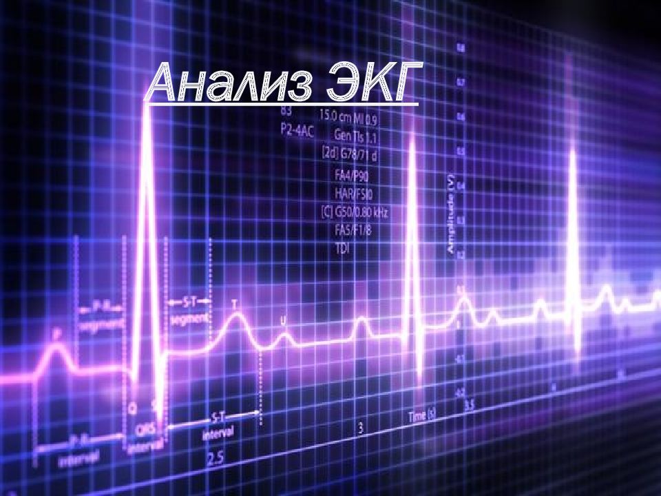Анализ ЭКГ