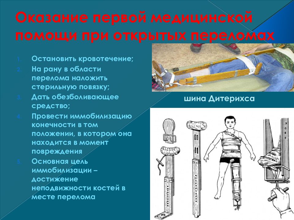 Подручные средства оказания 1 помощи. Деревянная шина Дитерихса. Иммобилизация подручными средствами. Оказание помощи при переломе подручными средствами. Транспортная иммобилизация подручными средствами.