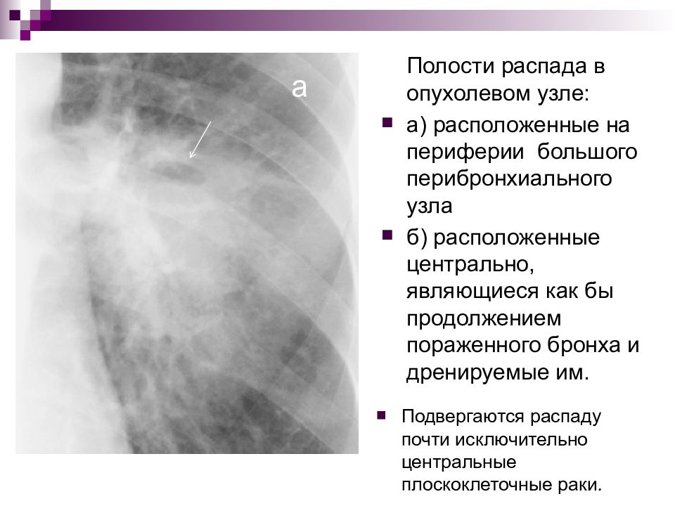 Лучевая диагностика рака легкого презентация