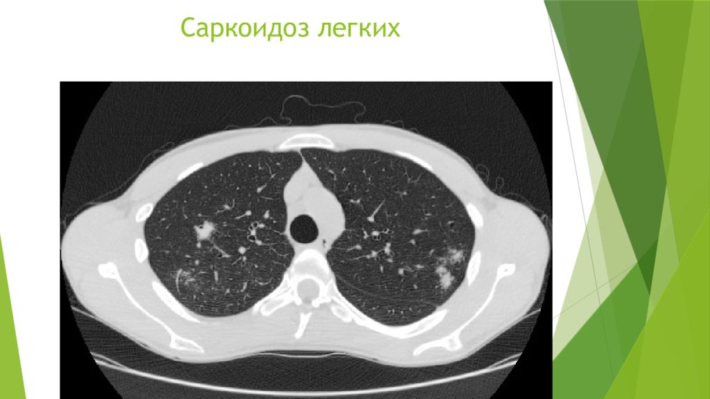 Саркоидоз фтизиатрия презентация