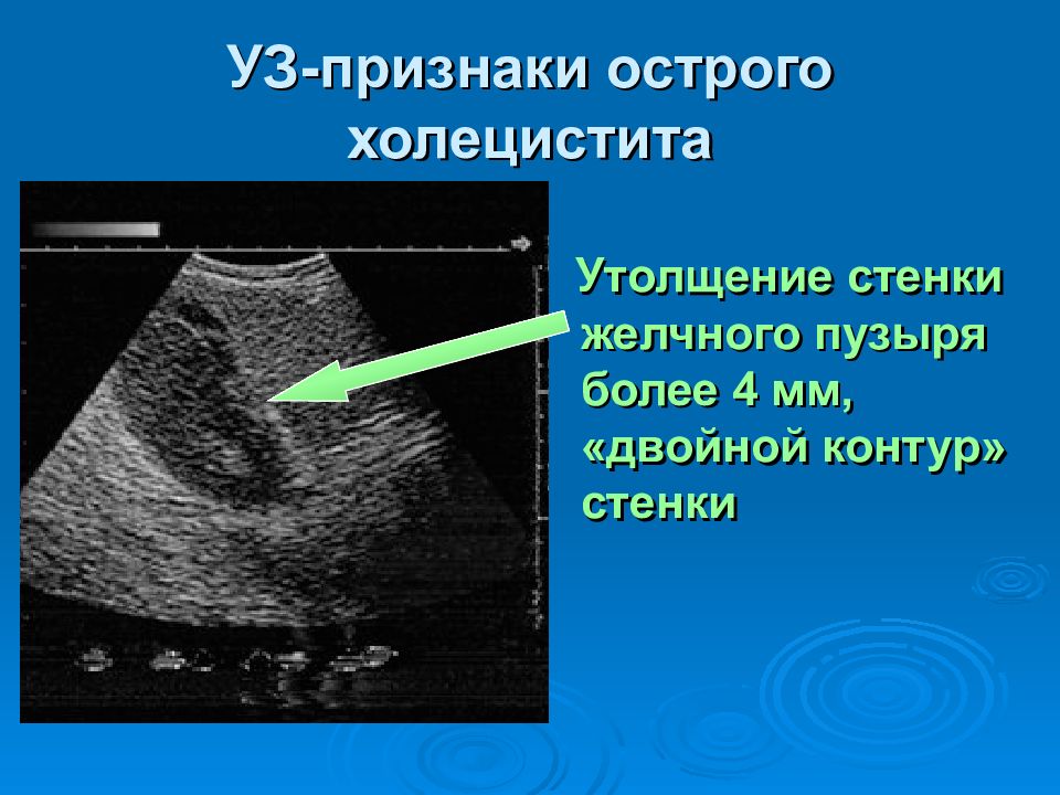 Обобщенная эхографическая картина рака желчного пузыря может быть представлена