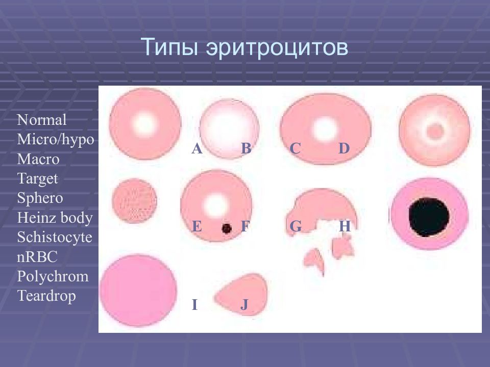 Типы эритроцитов. Эритроциты необычной формы. патологические формы эритроцитов. стоки эритроцитов гемобластозы.