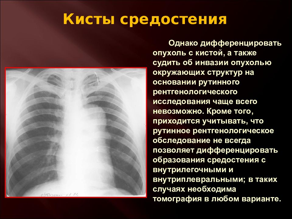 Рак средостения. Доброкачественная опухоль средостения рентген. Злокачественная опухоль средостения рентген. Злокачественная опухоль средостения рентген схема. Образования средостения.