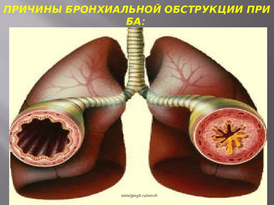 Обструкция легких. Бронхиальная астма обструкция. Обструкция бронхов при бронхиальной астме. Бронхиальная астма обструктивный синдром.