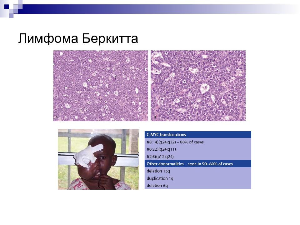 Лимфом беркитта. Инфекционный мононуклеоз лимфома Беркитта. Лимфома Беркитта патологическая анатомия. Лимфома Беркитта болезнь. Лимфома Беркитта клинические рекомендации.