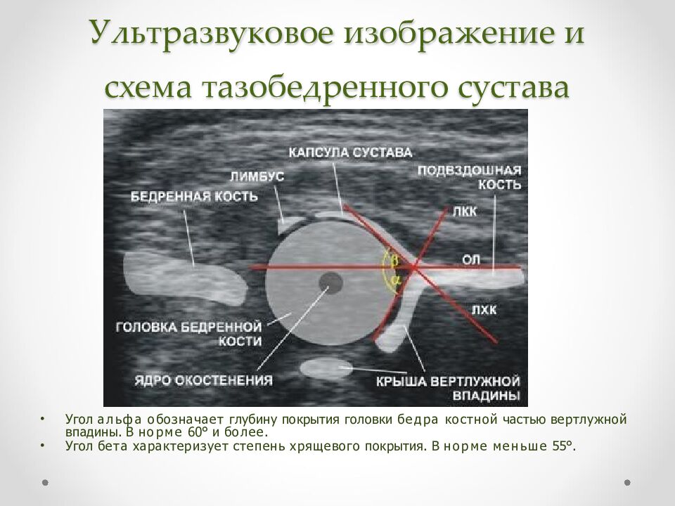 Ультразвуковое изображение и схема тазобедренного сустава