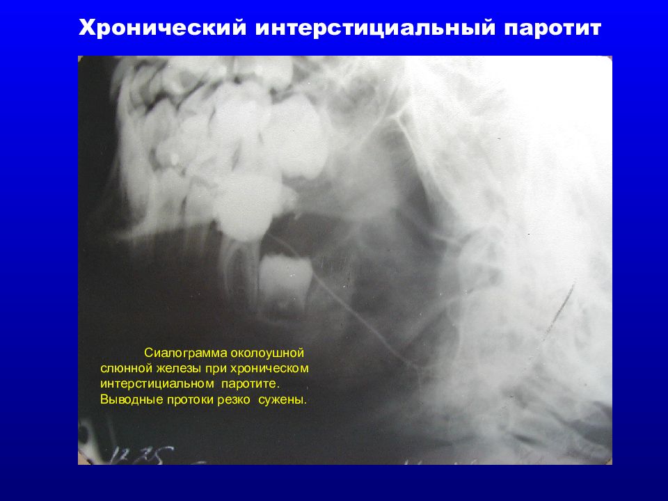 Заболевания слюнных желез у детей презентация