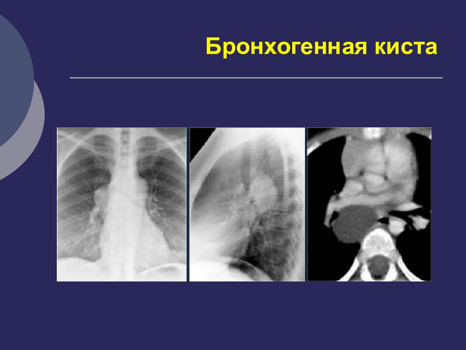 Кисты легких у детей презентация