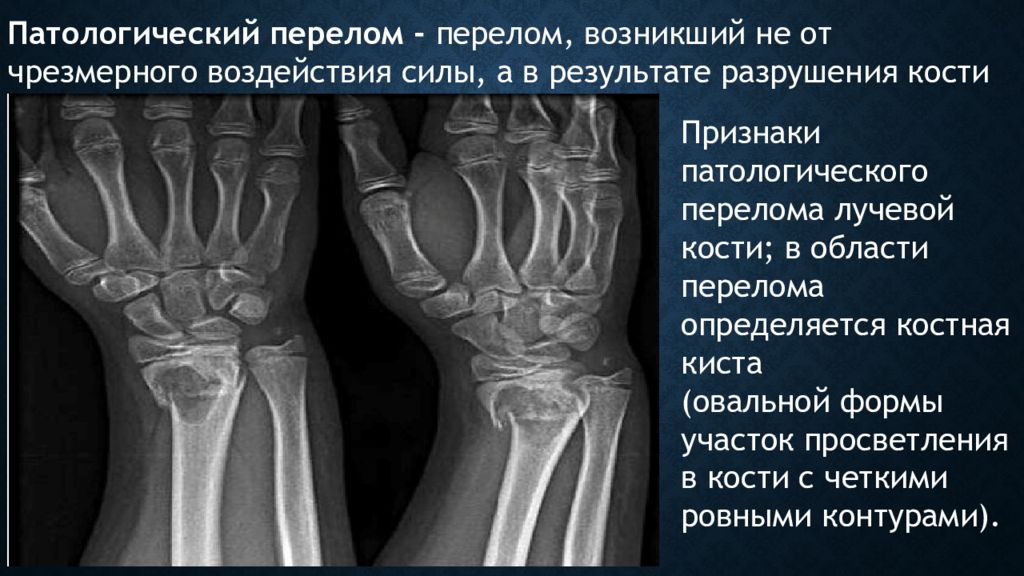 Патологический перелом. Травматические и патологические переломы. Рентгенологические симптомы перелома кости. Патологические переломы костей.