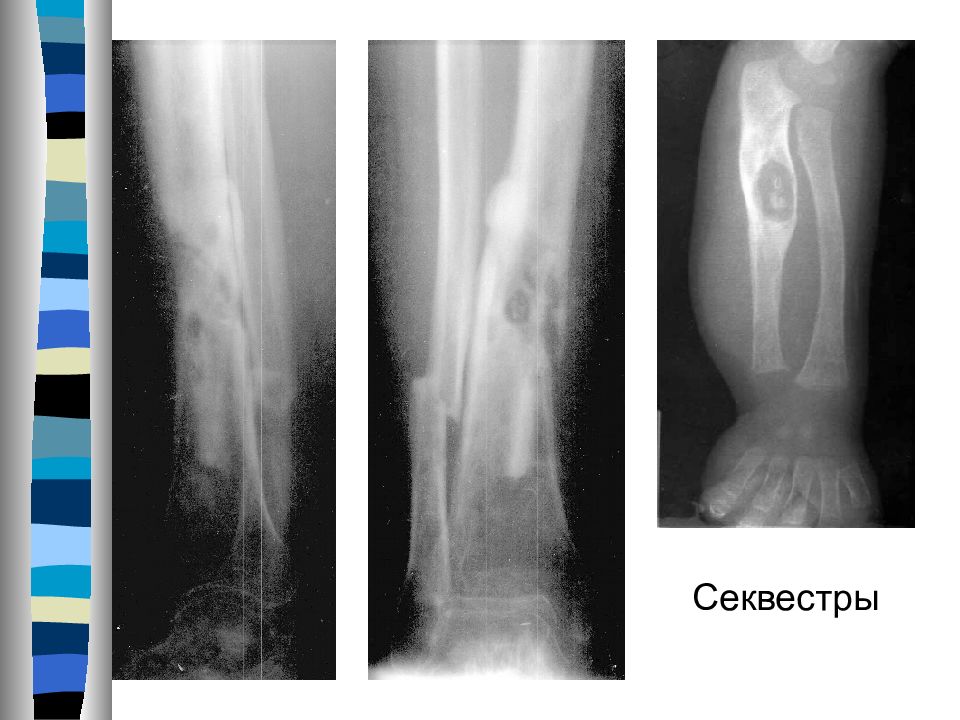 Вторичное поражение костей. Рентгеносемиотика линейных переломов. Экзостозная болезнь костей.