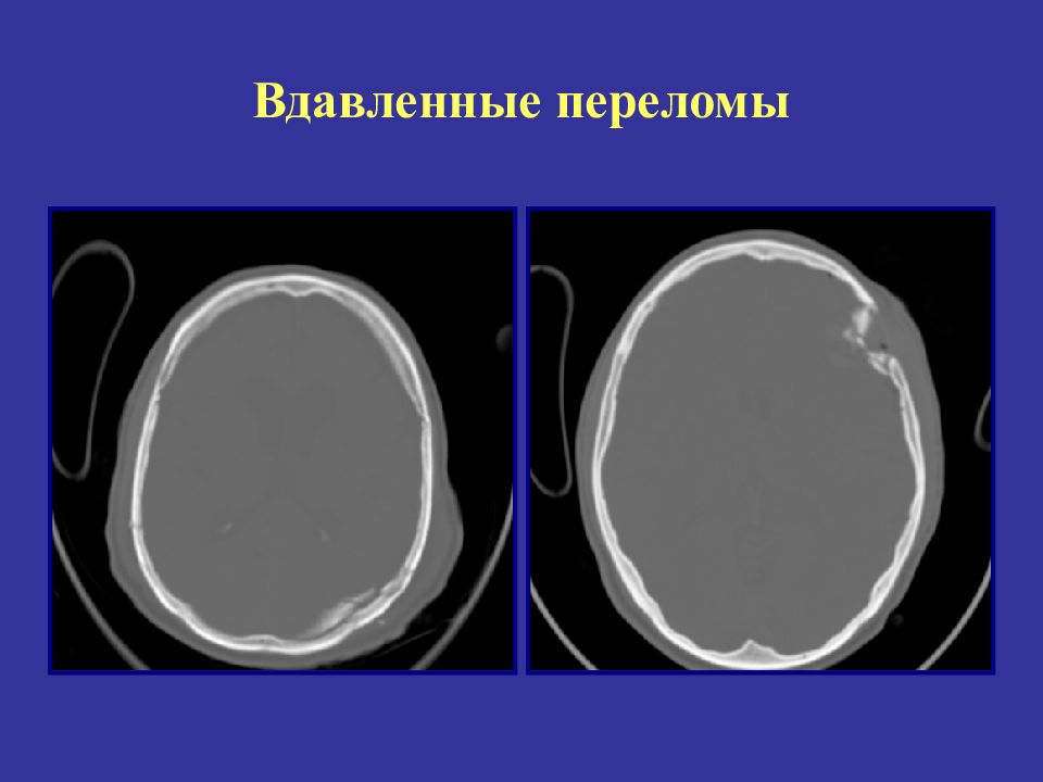 Перелом теменной кости у грудного. Перелом теменной кости черепа. Вдавленный перелом костей черепа кт. Импрессионный перелом черепа рентген. Вдавленный перелом теменной кости кт.