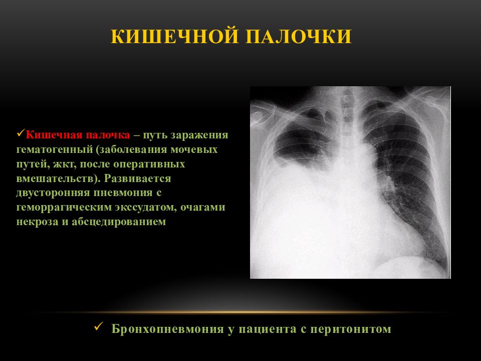 Палочка пневмонии. Пневмония вызванная кишечной палочкой. Пневмония вызванная синегнойной палочкой рентген. Кишечная палочка пневмония.