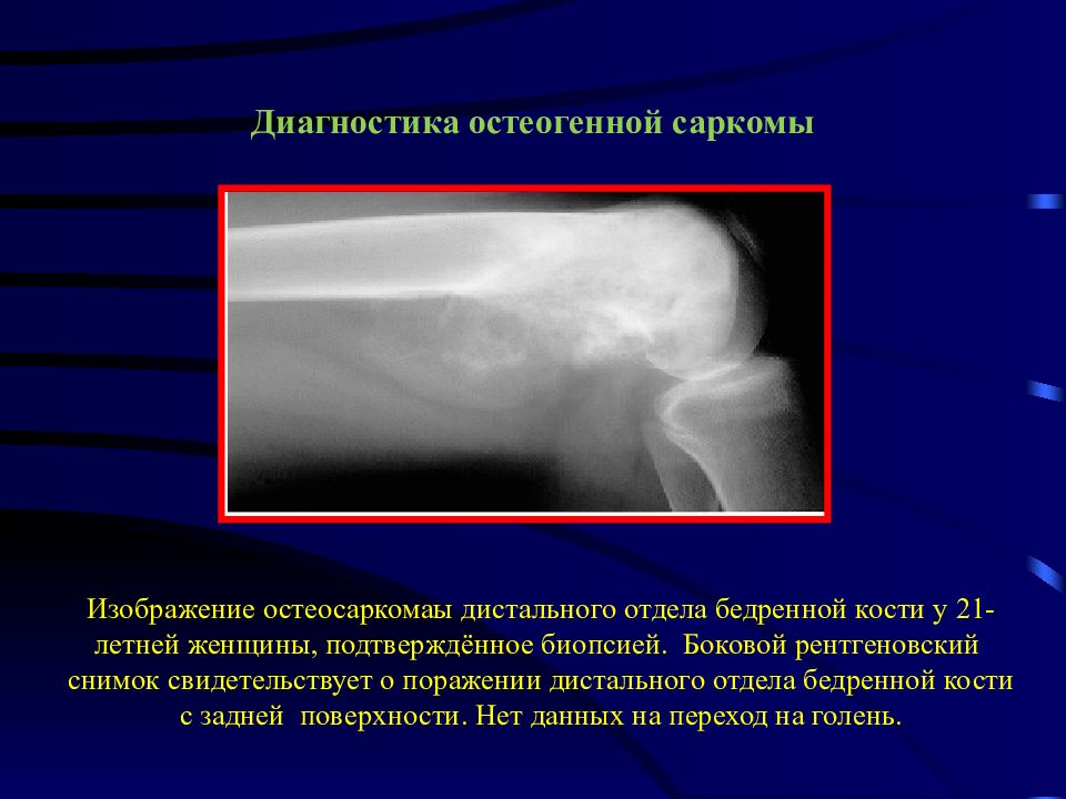 Опухоли костей схема