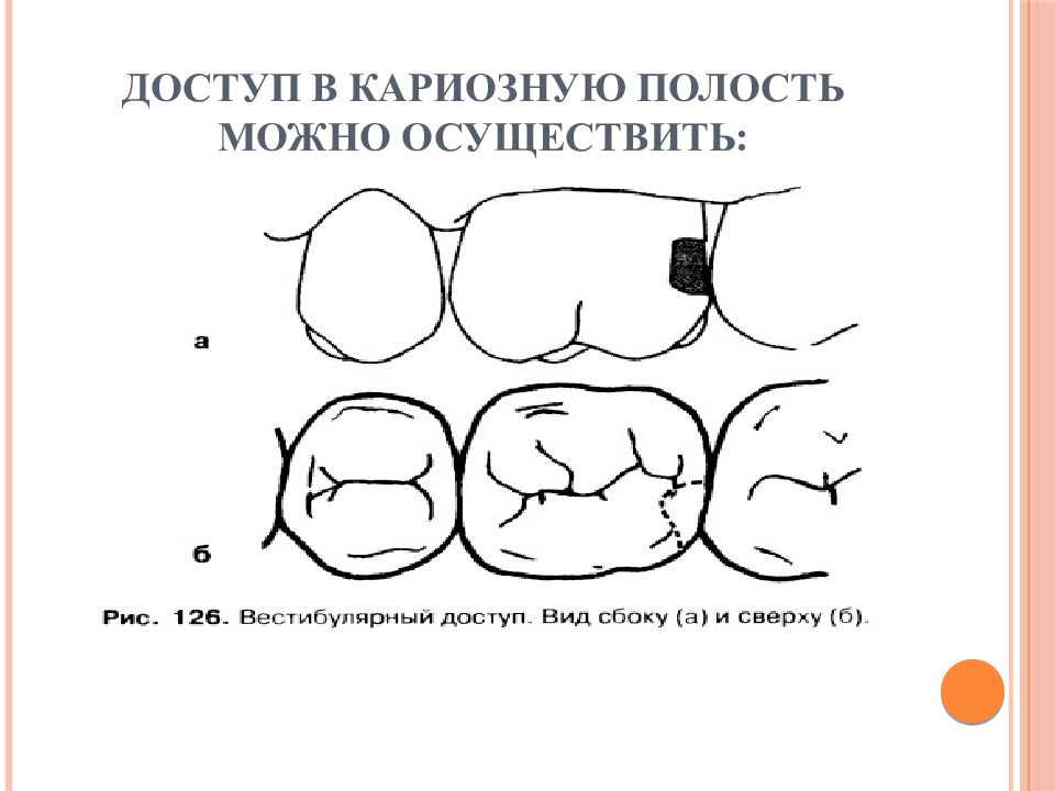 Размер кариозной полости. Доступ к кариозной полости. Препарирование кариозных полостей. Доступ для раскрытия кариозной полости.