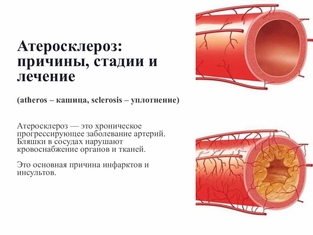 Атеросклероз: причины, стадии и лечение (atheros – кашица, sclerosis –