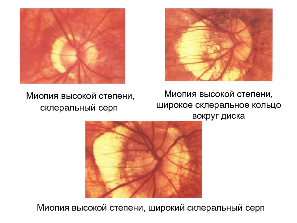 Степени миопии. Миопия высшей степени. Осложненная миопия высокой степени.