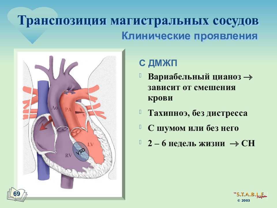 Транспозиция артерий