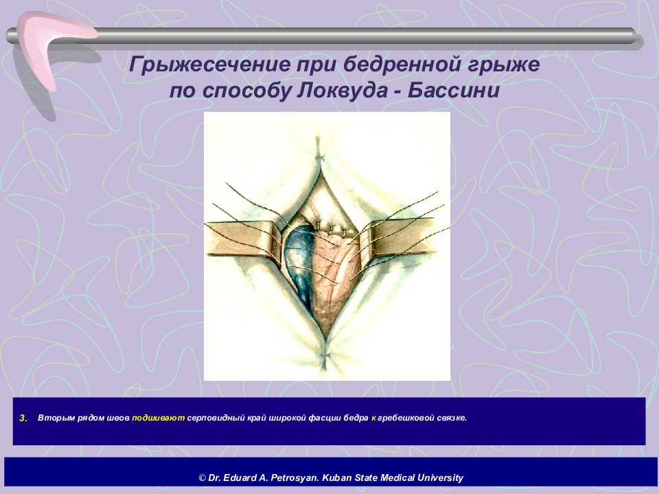 Бедренный способ. Бассини бедренная грыжа. Бедренная грыжа способ Бассини. Пластика по Бассини при бедренной грыже.