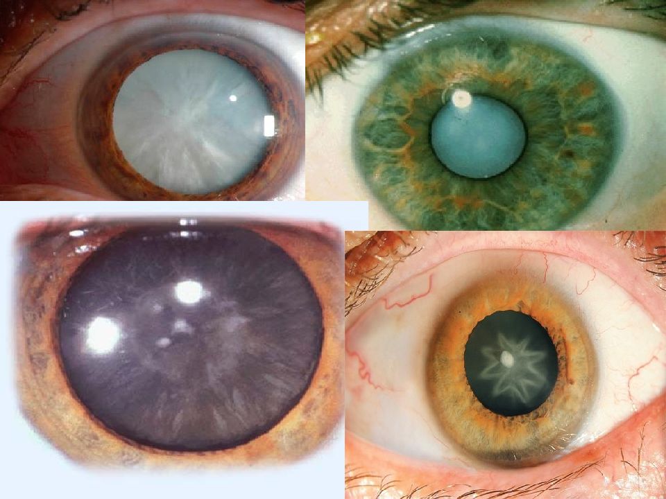 Катаракта глаза лучшие хрусталики. Биомикроскопия глаза катаракта. Ядерная катаракта биомикроскопия. Кольцевидная катаракта Фоссиуса. Заднекапсулярная катаракта.