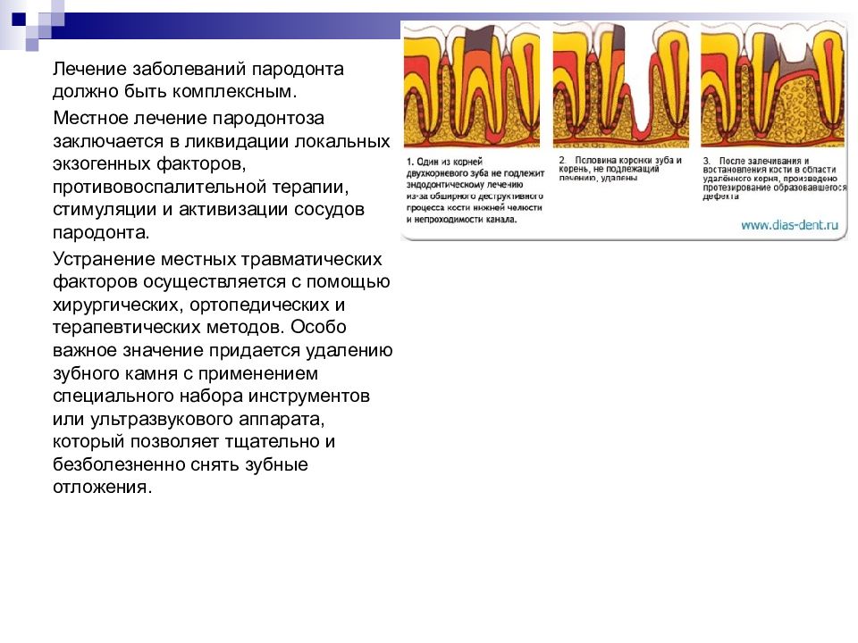 Методы лечения заболевания пародонта