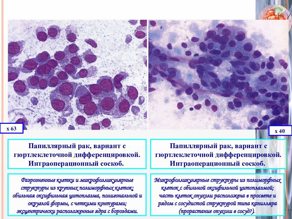 Щитовидная железа цитологическая картина. Цитологическая картина опухоли щитовидной железы. Гюртлеклеточная аденома щитовидной железы. Цитологическая картина фолликулярной опухоли щитовидной железы. Цитологическая картина папиллярной карциномы щитовидной железы.