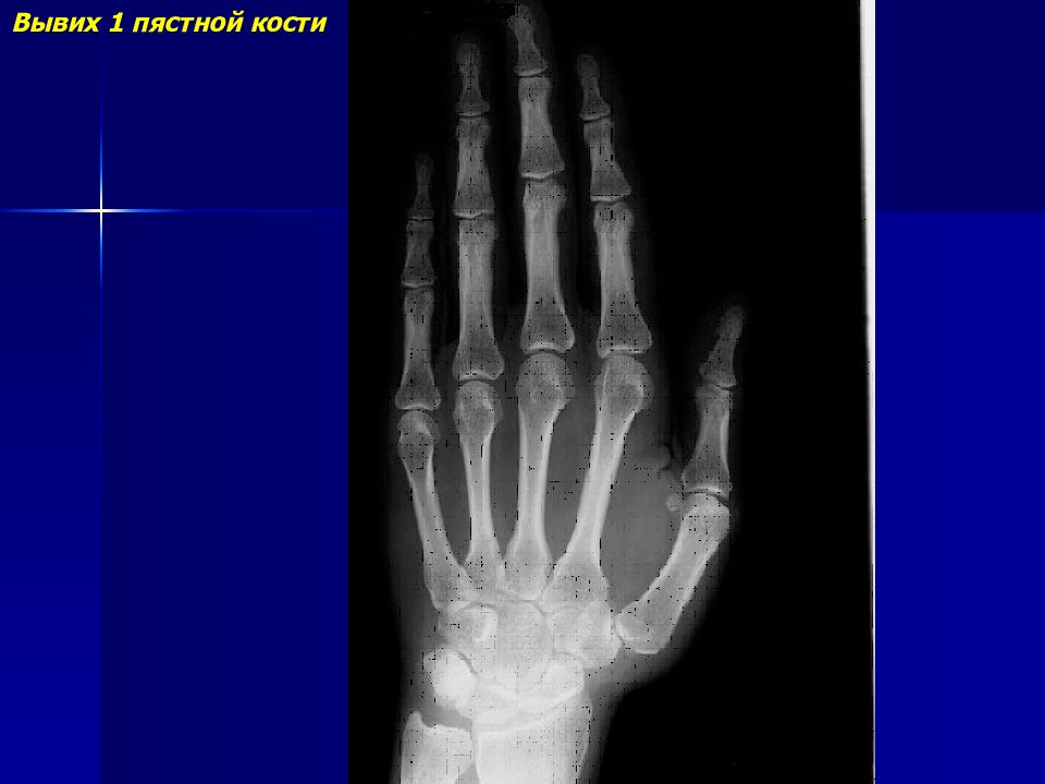 2 пястная кость. Вывих головки 1 пястной кости кисти. Подвывих 1 пястно фалангового сустава рентген. Синостоз первой пястной кости. Подвывих пястной кости 1 пальца.
