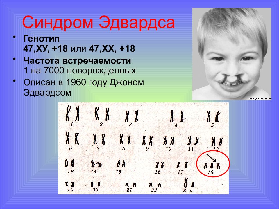 Генотип 16 45. Синдром Эдвардса генотип. Синдром Эдвардса трисомия. Синдром Эдвардса (трисомия 18). Трисомия по 18 хромосоме синдром Эдвардса.