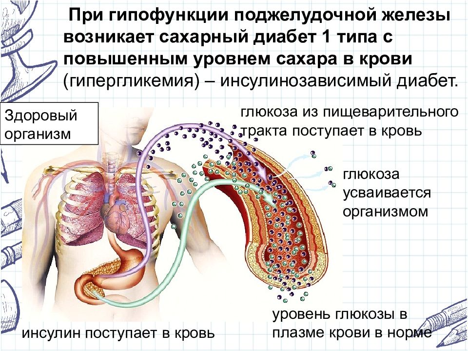 При гипофункции развивается сахарный диабет поджелудочная железа. Гипофункция поджелудочной железы. Проявление гипофункции поджелудочной железы. Гипофункция инсулина. Гипофункция глюкагона.