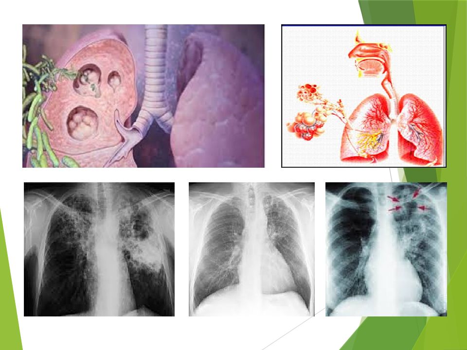 O'PKA OBSTRUKTIV YETISHMOVCHILIGI DIAGNOSTIKASI O'PKA OBSTRUKTIV YETISHMOVCHILIGI DIAGNOSTIKASI
