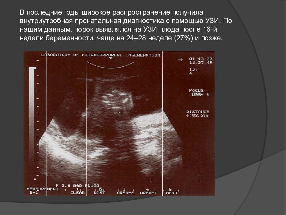 Спинномозговые грыжи презентация