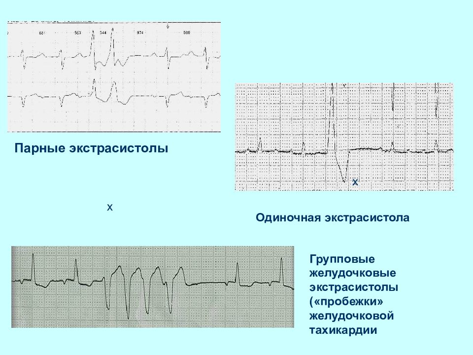 Экг при нарушениях ритма и проводимости презентация