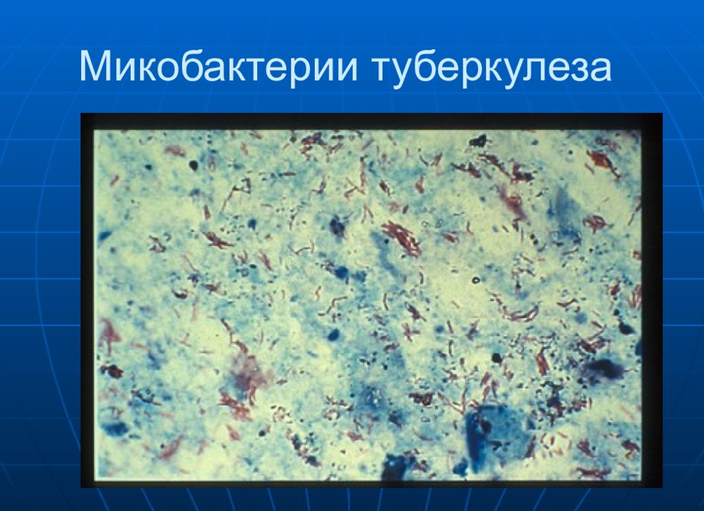 Тест на микобактерию. Mycobacterium tuberculosis микробиология препарат. Микобактерии микробиология. Туберкулез микробиология. Туберкулез препарат микробиология.