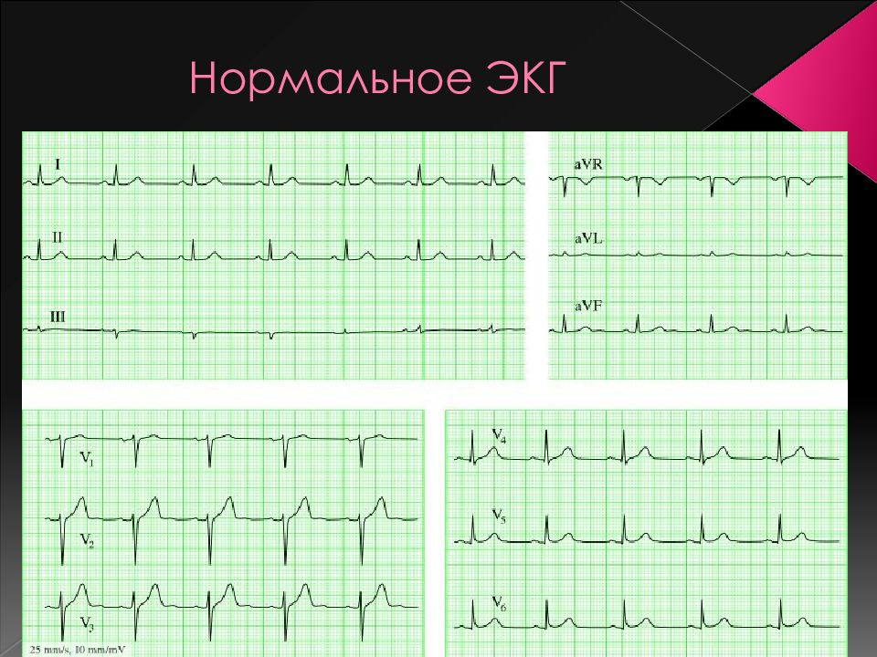 Экг презентация терапия