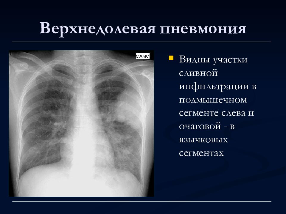 Левосторонняя очаговая пневмония. Левосторонняя верхнедолевая пневмония рентген. Левосторонняя очаговая пневмония рентген. Рентген верхнедолевой правосторонней пневмонии. Левая верхнедолевая пневмония на рентгене.