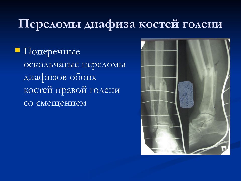 Рассмотрите рентгенограмму с изображением голени человека как называют повреждение которое