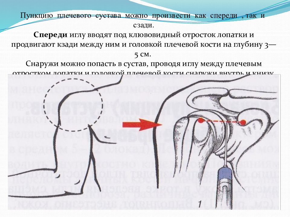 Пункция плечевого сустава