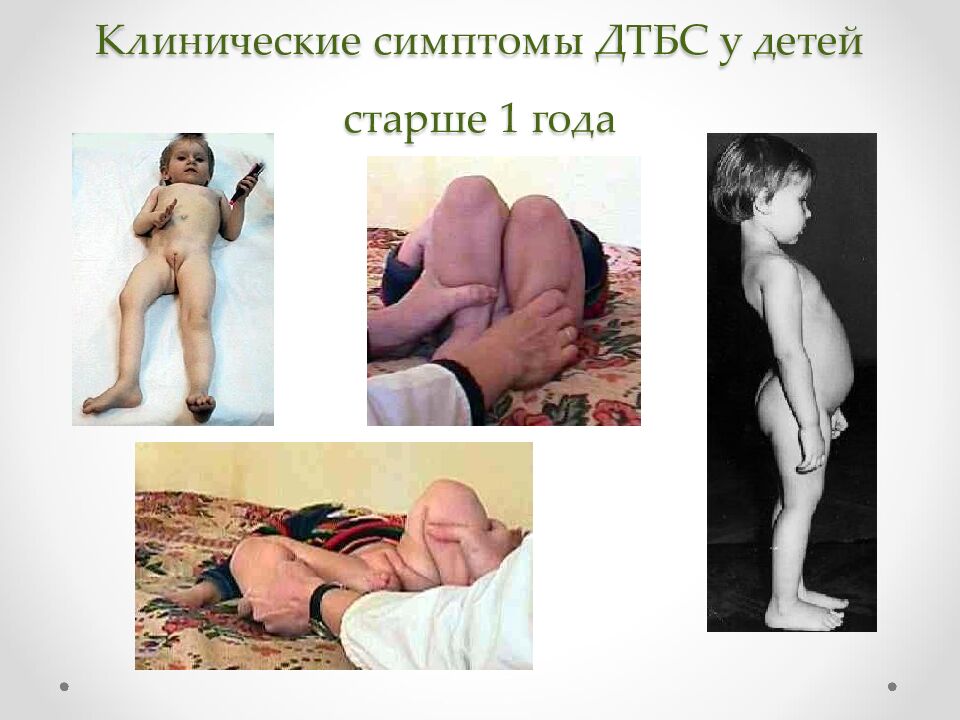 Клинические симптомы ДТБС у детей старше 1 года