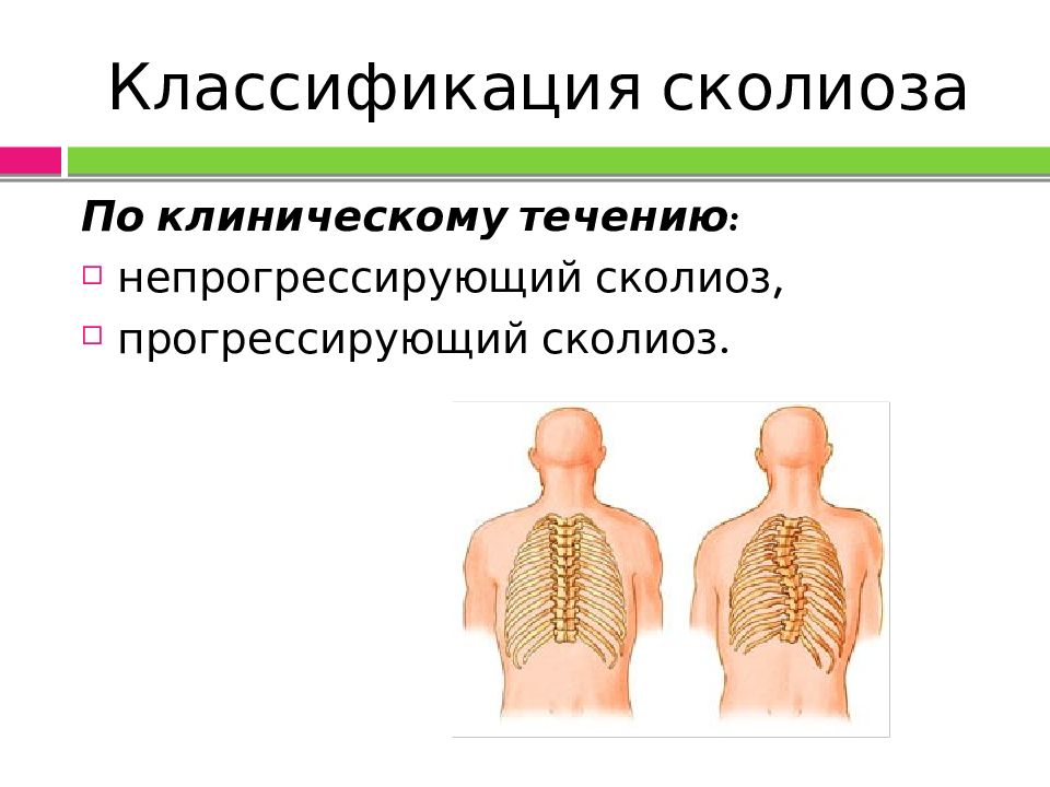 Что такое сколиоз. Искривление позвоночника классификация. Классификация сколиоза у детей. Градусы искривления позвоночника.