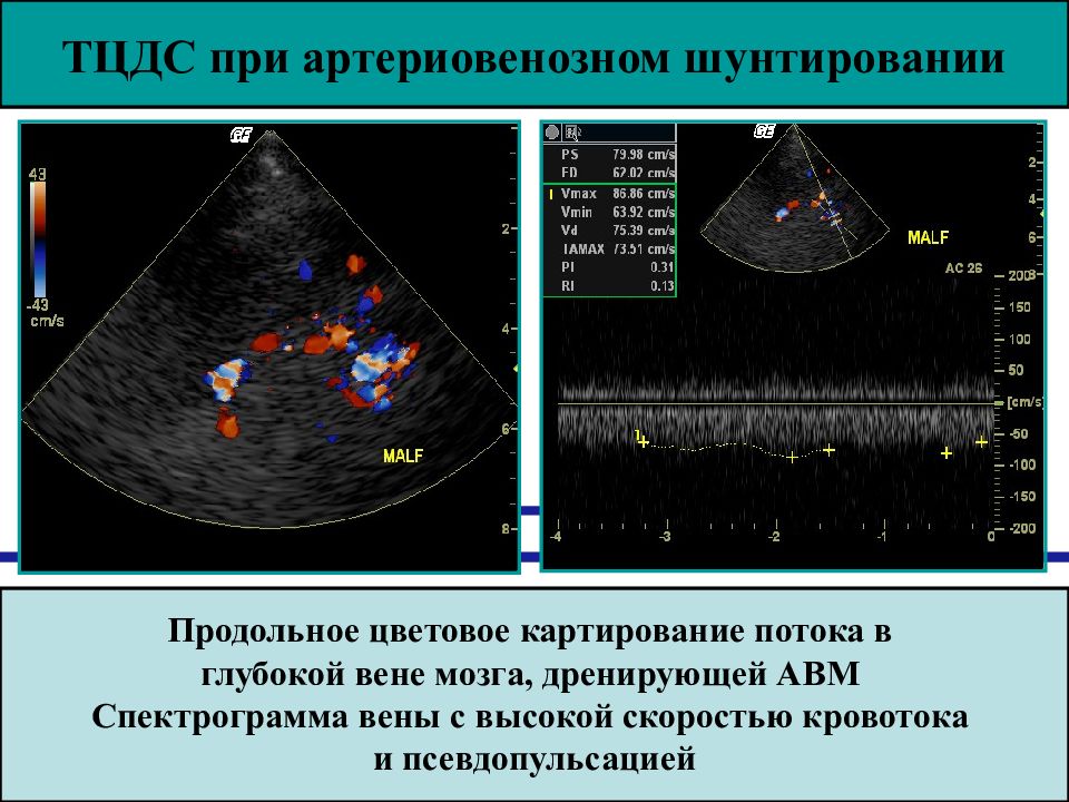 Измерение кровотока. Цветовое допплеровское картирование ЦДК. Цветовое картирование в УЗИ. Кровоток в венах на УЗИ.