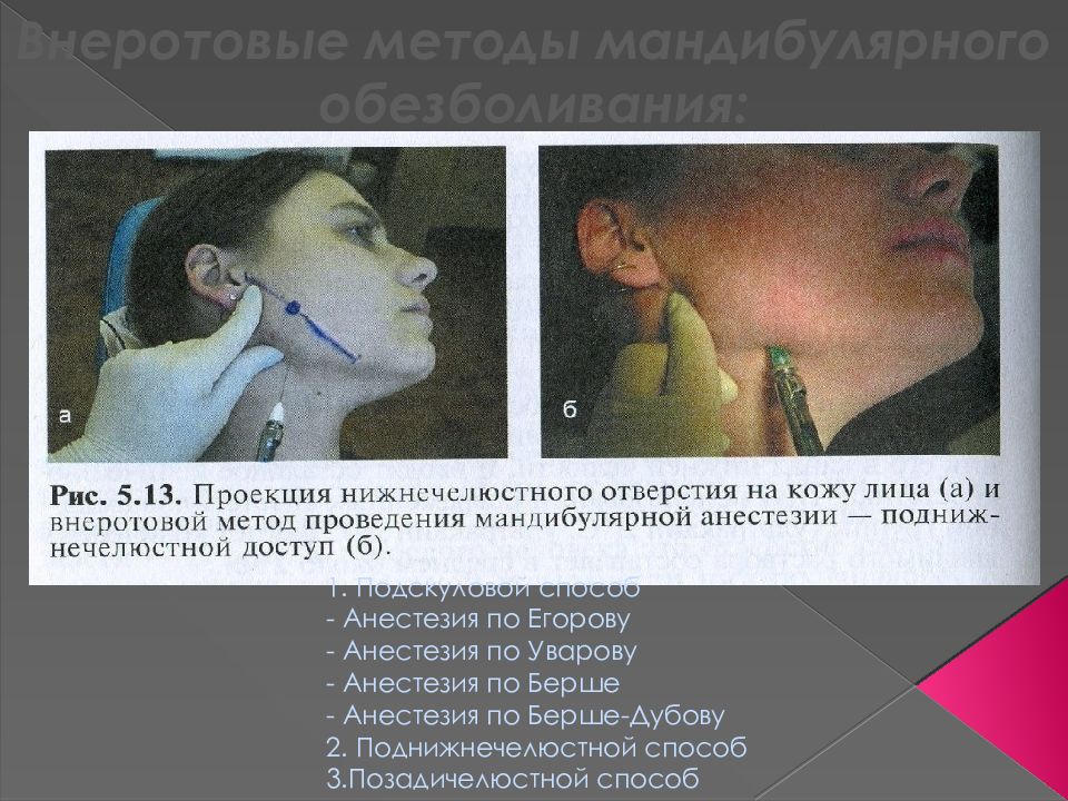 Мандибулярная анестезия презентация